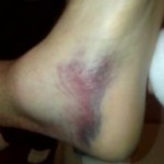 Brett Favre Bruised Ankle