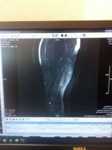 arian foster hamstring mri