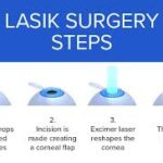 lasik